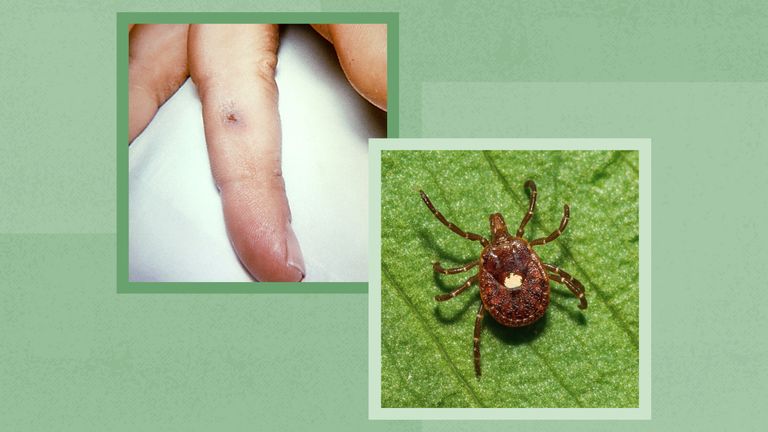 Ticks making people sick