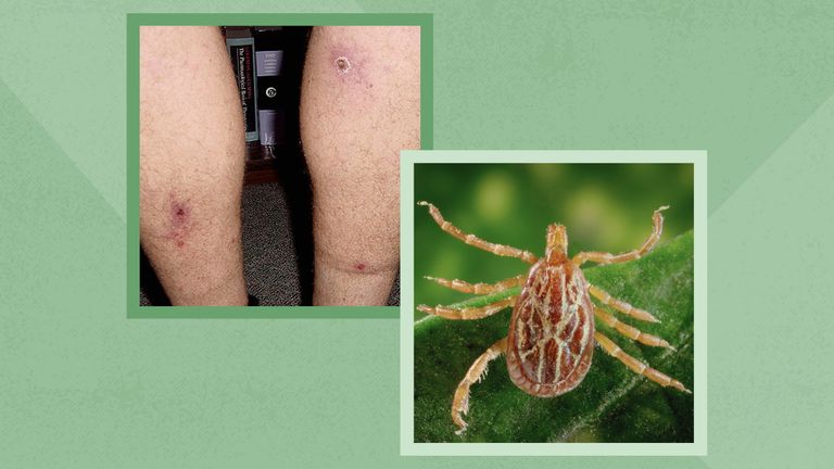 Gulf Coast Ticks and Spotted Fever