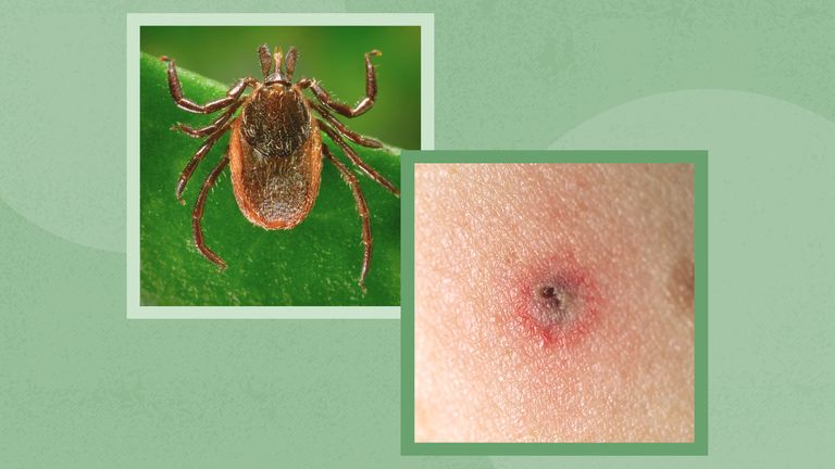 Ticks and Anaplasmosis